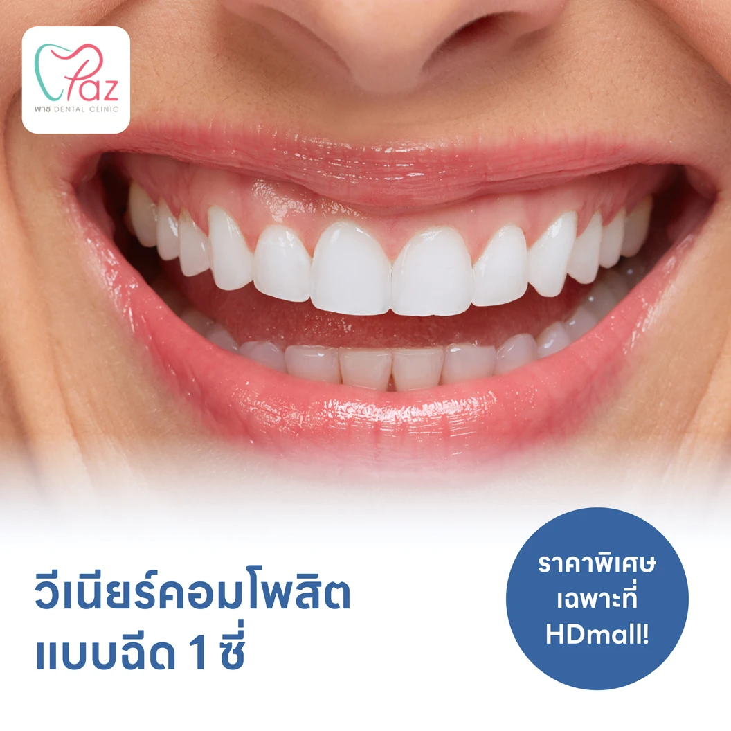 ทำวีเนียร์คอมโพสิตแบบฉีด 1 ซี่