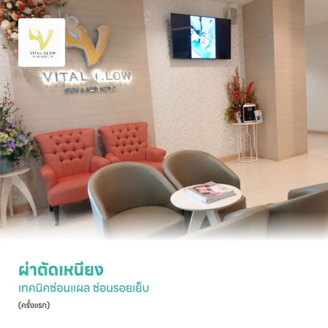ผ่าตัดเหนียง เทคนิคซ่อนแผล ซ่อนรอยเย็บ (ครั้งแรก)