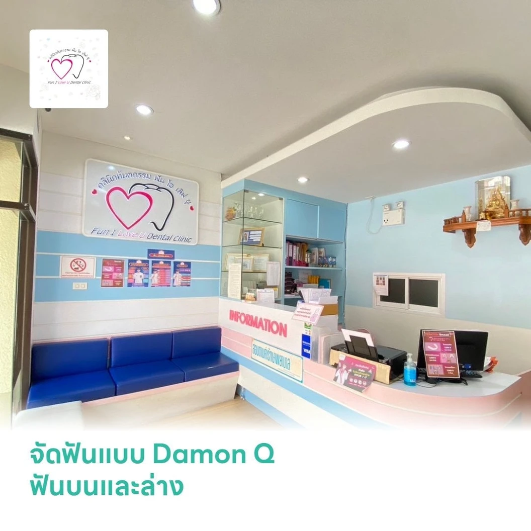 จัดฟันแบบ Damon Q ฟันบนและล่าง