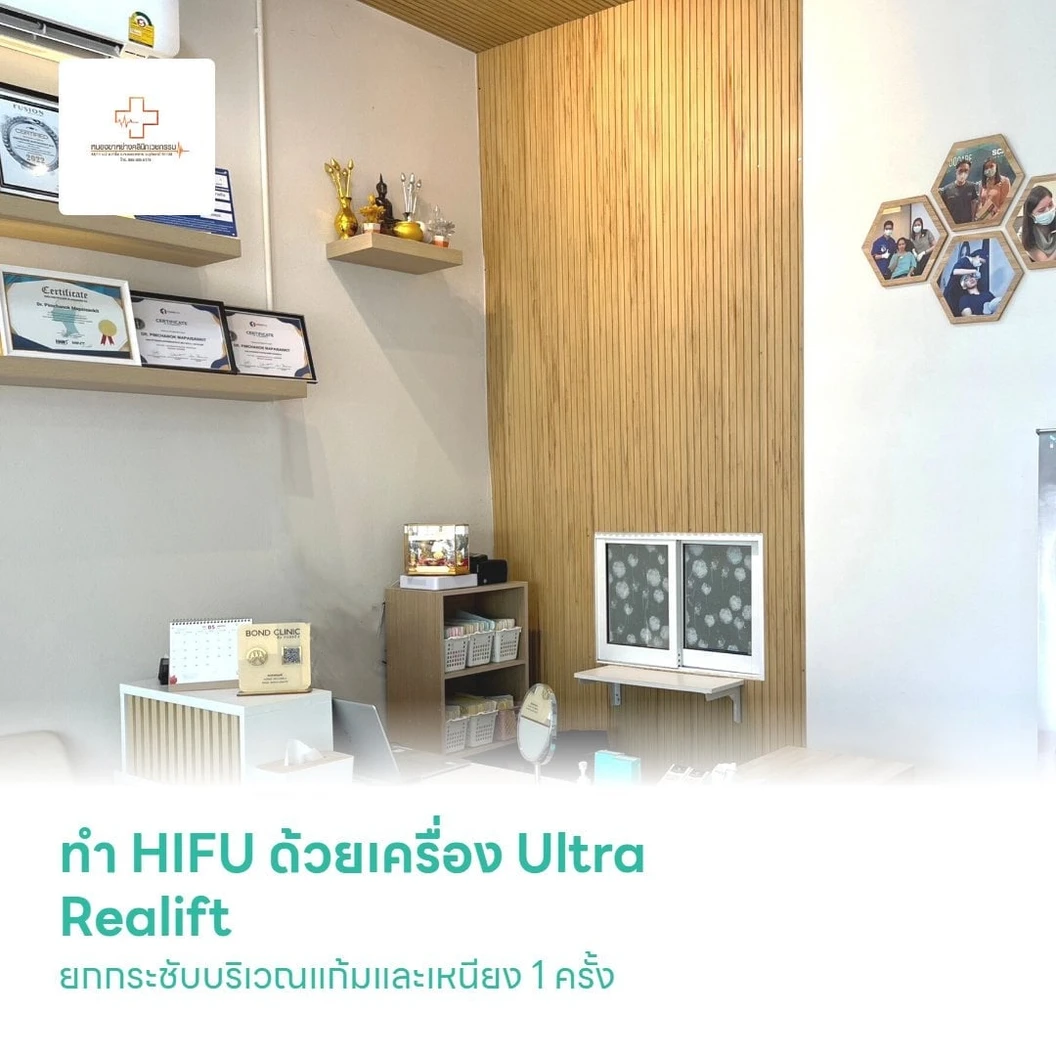 ทำ HIFU ด้วยเครื่อง Ultra Realift เพื่อยกกระชับบริเวณแก้มและเหนียง 1 ครั้ง