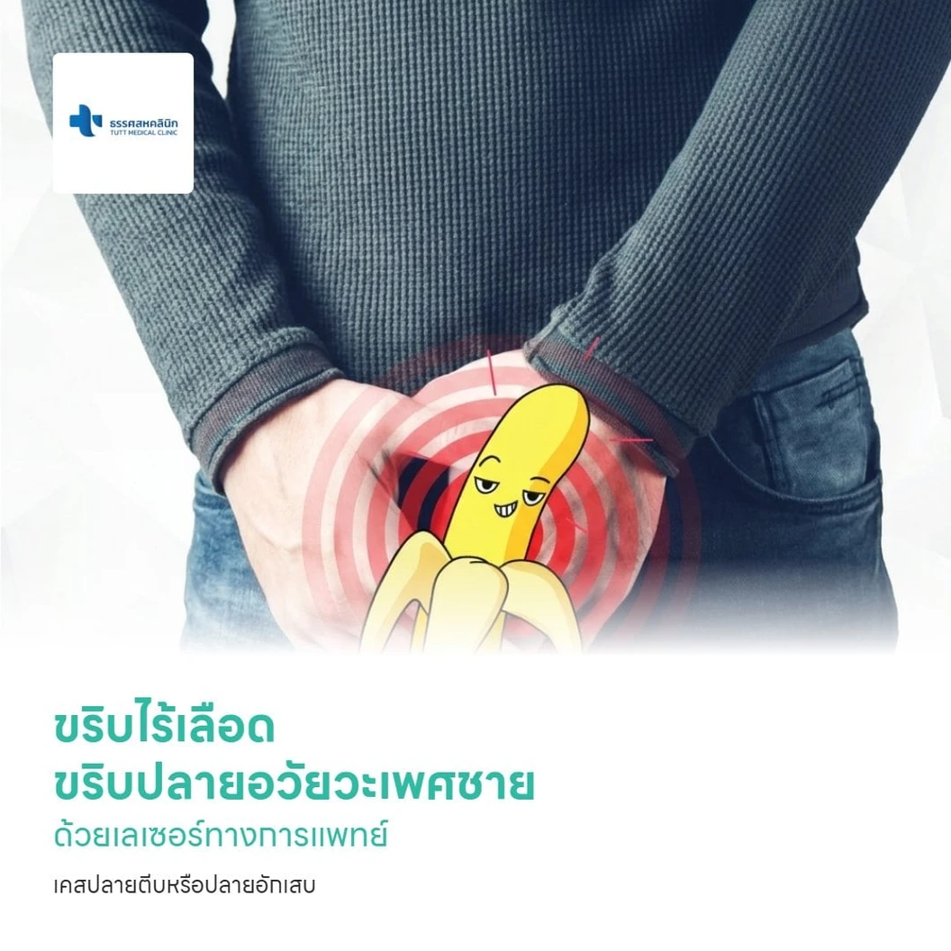 ขริบปลายอวัยวะเพศชาย ด้วยเลเซอร์ทางการแพทย์ เคสปลายตีบหรือปลายอักเสบ สำหรับผู้ที่อายุ 15 ปีขึ้นไป
