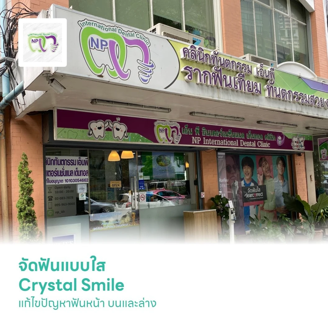 จัดฟันแบบใส Crystal Smile แก้ไขปัญหาฟันหน้า บนและล่าง