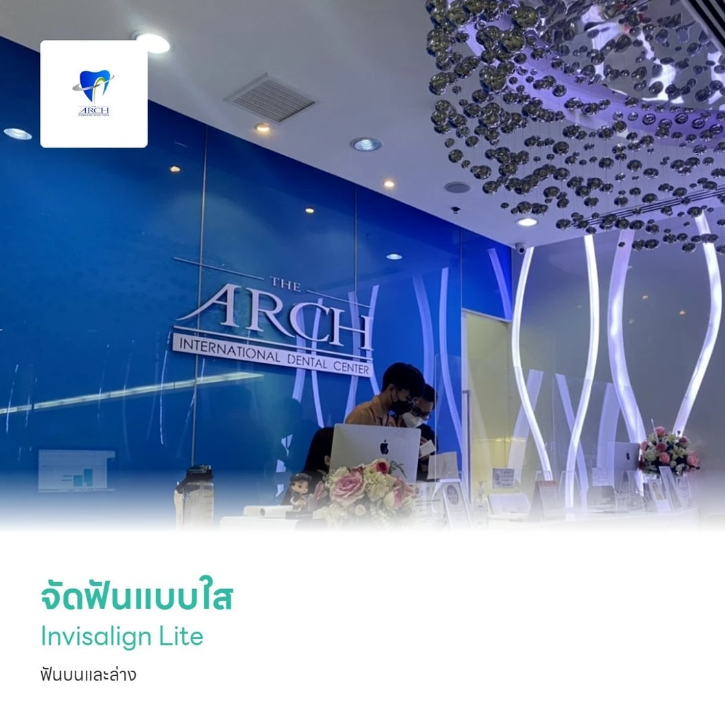 จัดฟันแบบใส Invisalign Lite ฟันบนและล่าง