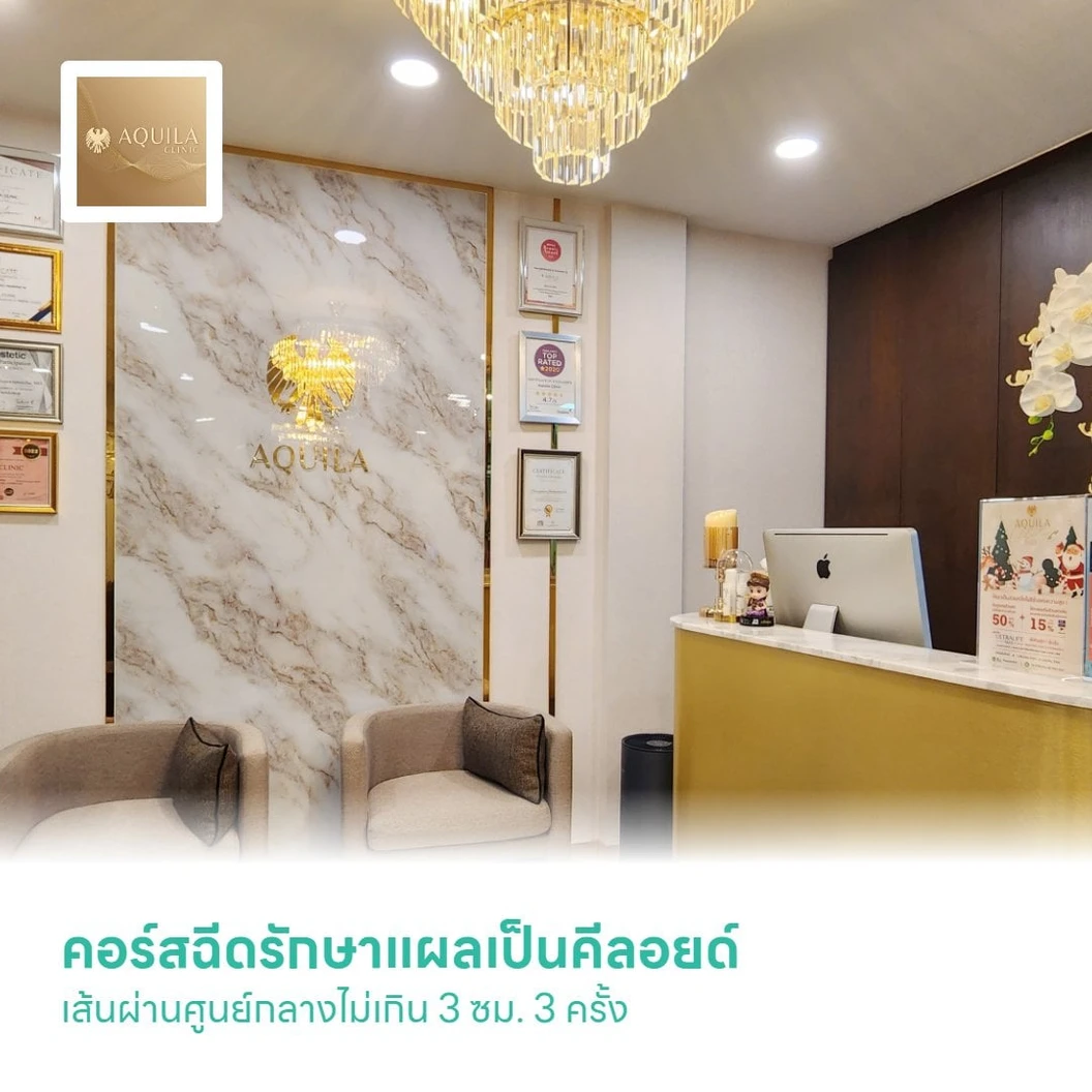 คอร์สฉีดรักษาแผลเป็นคีลอยด์ เส้นผ่านศูนย์กลางไม่เกิน 3 ซม. 3 ครั้ง