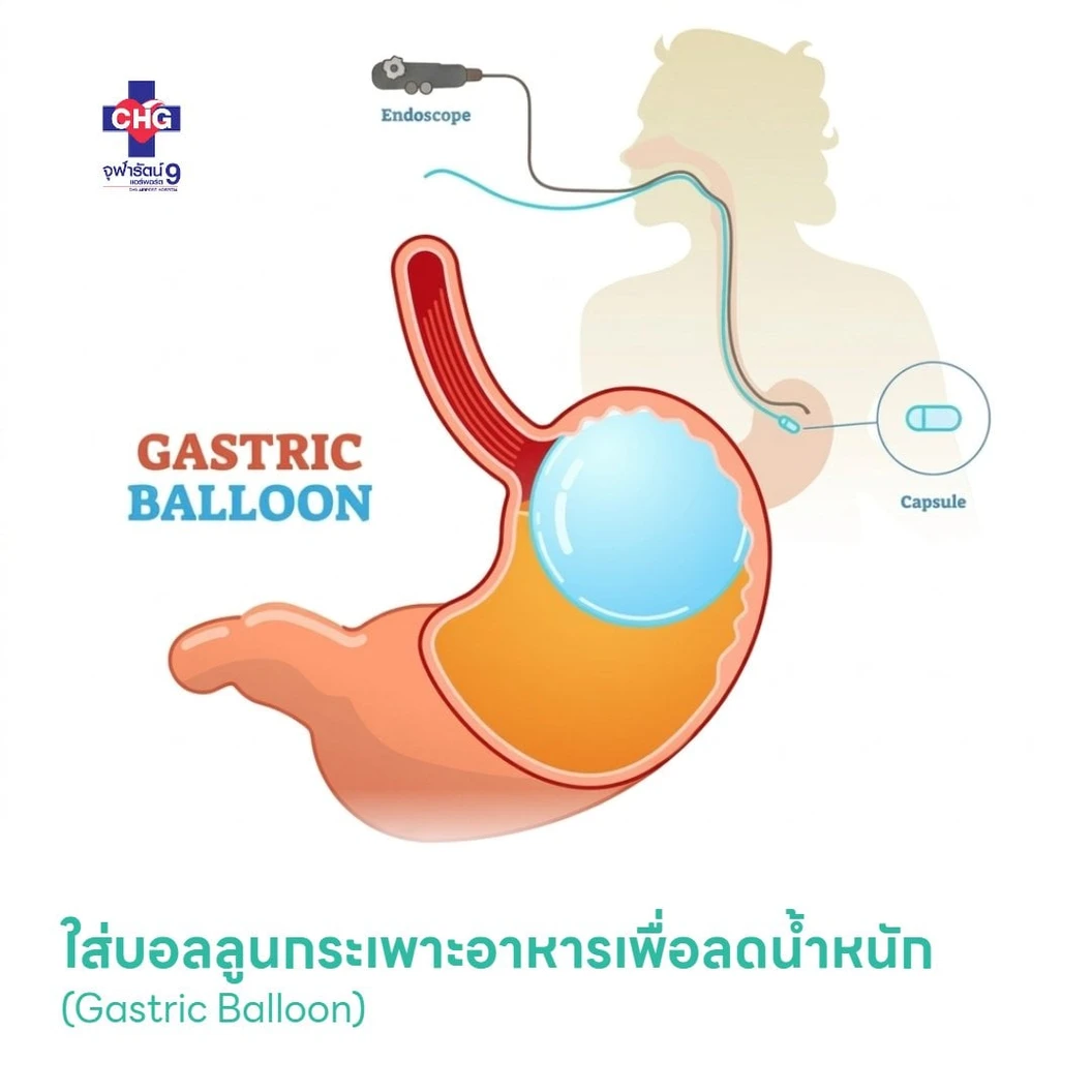 ใส่บอลลูนกระเพาะอาหารเพื่อลดน้ำหนัก (Gastric Balloon)