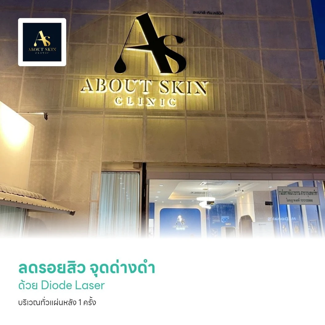 ลดรอยสิว จุดด่างดำ ด้วย Diode Laser บริเวณทั่วแผ่นหลัง 1 ครั้ง