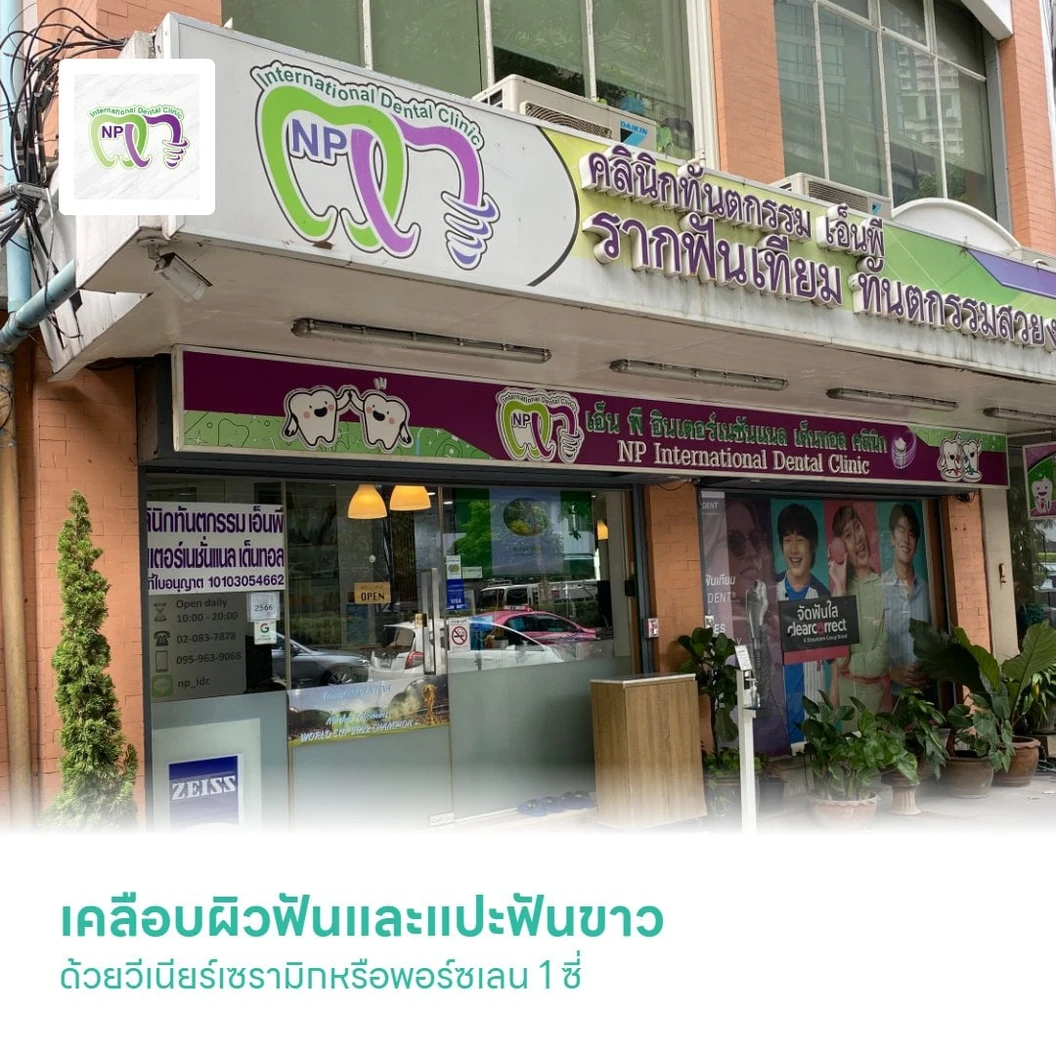 เคลือบผิวฟันและแปะฟันขาว ด้วยวีเนียร์เซรามิกหรือพอร์ซเลน 1 ซี่