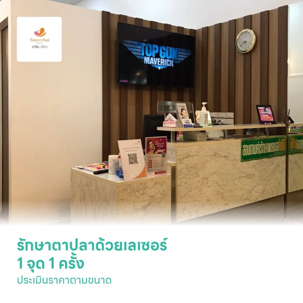รักษาตาปลาด้วยเลเซอร์ 1 จุด 1 ครั้ง ประเมินราคาตามขนาด