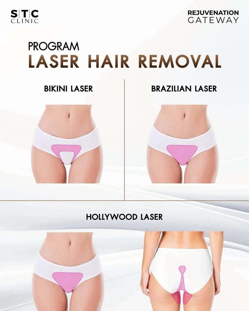 กำจัดขน Bikini ด้วย Triplex Diode Laser 1 ครั้ง สำหรับผู้หญิงหรือผู้ชาย
