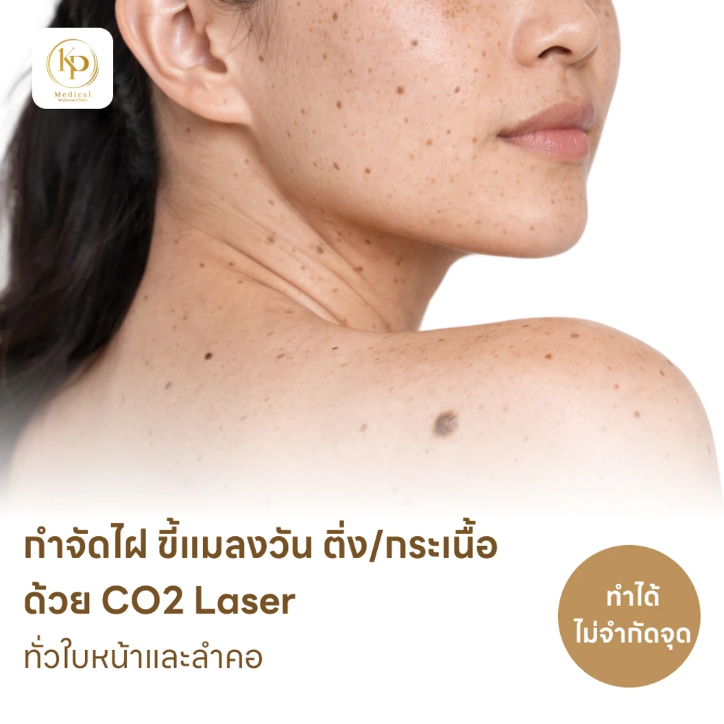กำจัดไฝ ขี้แมลงวัน ติ่งเนื้อ กระเนื้อ ด้วย CO2 Laser ขนาดเส้นผ่านศูนย์กลางไม่เกิน 2 มม. ไม่จำกัดจุดทั่วใบหน้าและลำคอ 1 ครั้ง