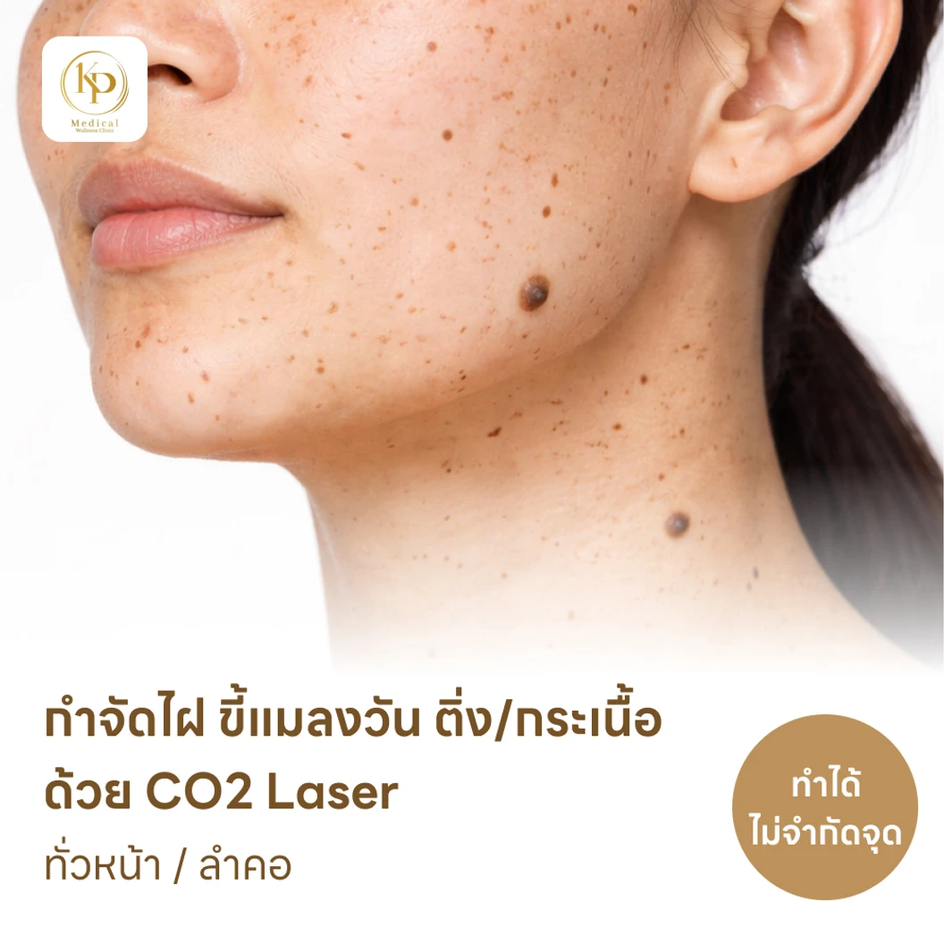 กำจัดไฝ ขี้แมลงวัน ติ่งเนื้อ กระเนื้อ ด้วย CO2 Laser ขนาดเส้นผ่านศูนย์กลางไม่เกิน 2 มม. ไม่จำกัดจุดทั่วใบหน้าหรือลำคอ 1 ครั้ง