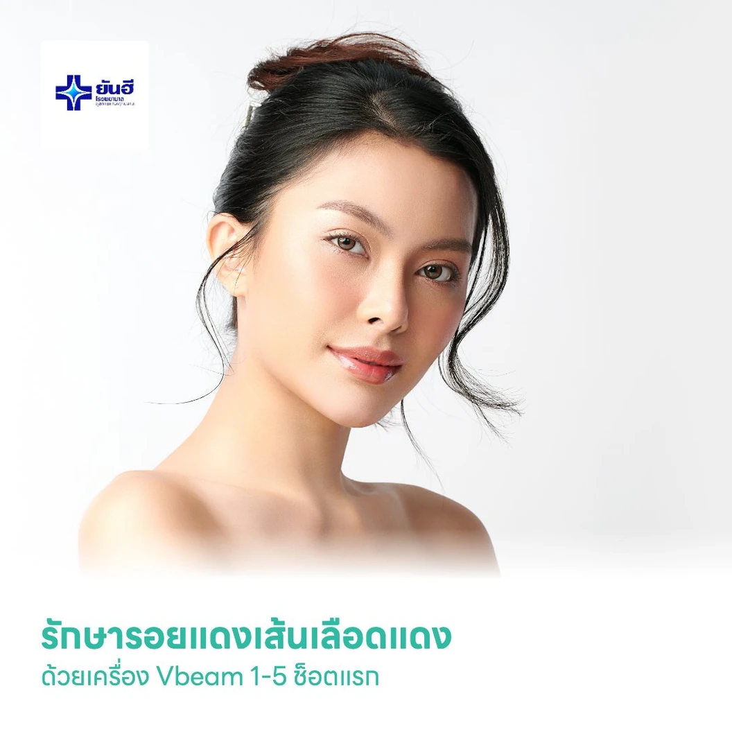 รักษารอยแดงเส้นเลือดแดง ด้วยเครื่อง Vbeam 1-5 ช็อตแรก