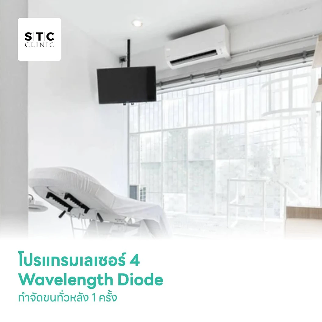โปรแกรมเลเซอร์ 4 Wavelength Diode กำจัดขนทั่วหลัง 1 ครั้ง