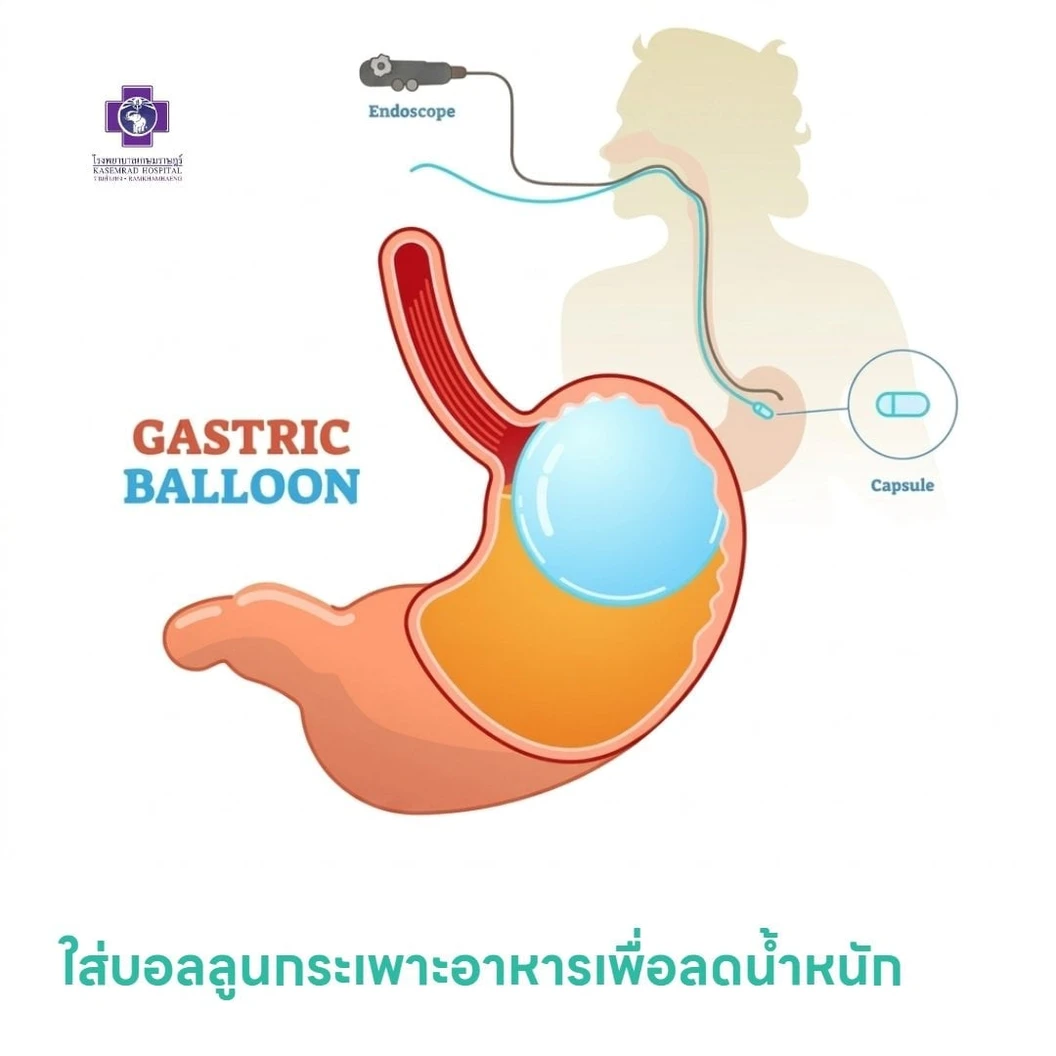 ใส่บอลลูนกระเพาะอาหารเพื่อลดน้ำหนัก (Gastric Balloon)