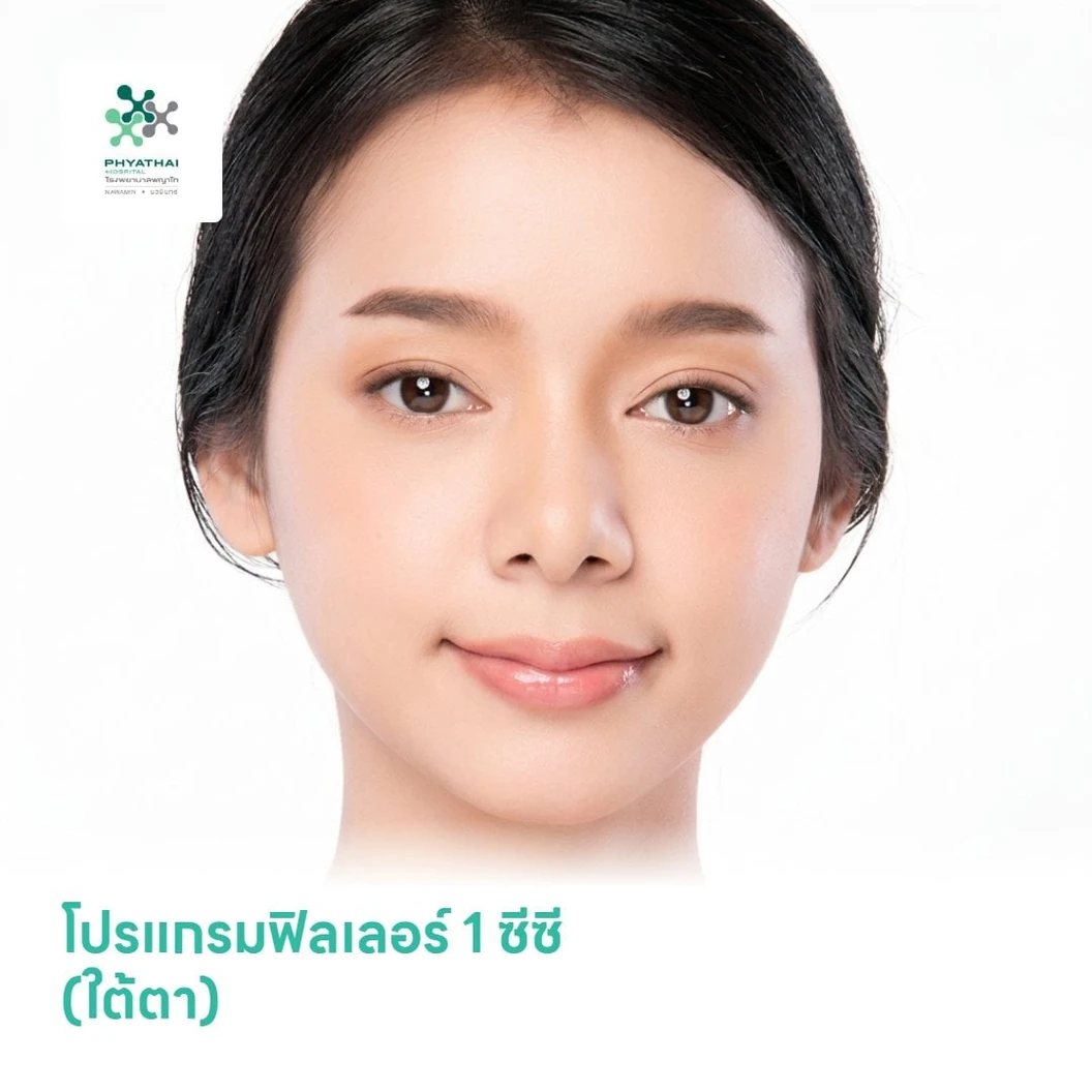 โปรแกรมฟิลเลอร์ 1 ซีซี (ใต้ตา)