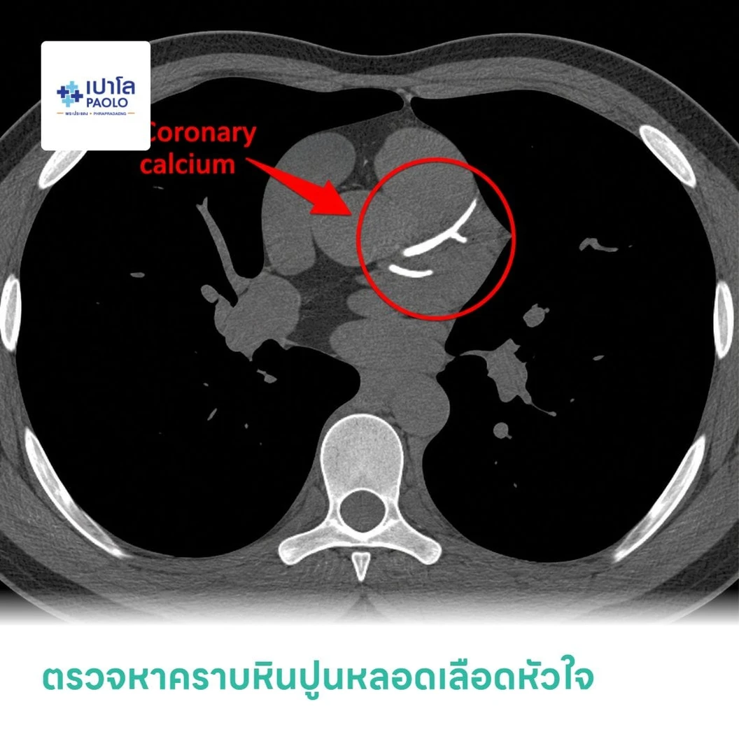 ตรวจหาคราบหินปูนหลอดเลือดหัวใจ (CT Calcium Score)