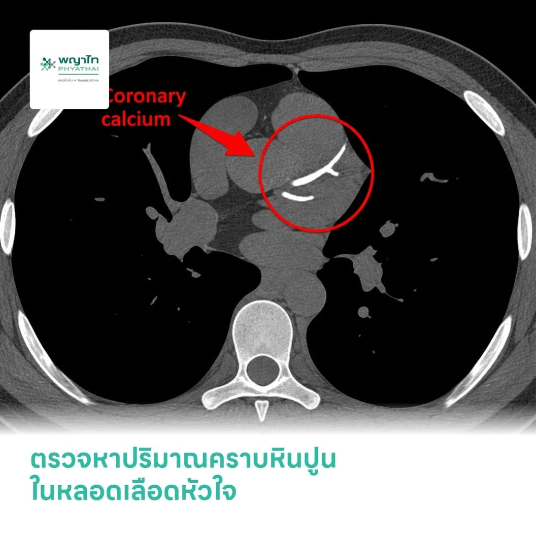 ตรวจหาปริมาณคราบหินปูนในหลอดเลือดหัวใจ (Calcium Scoring) ด้วยเครื่อง CT Scan