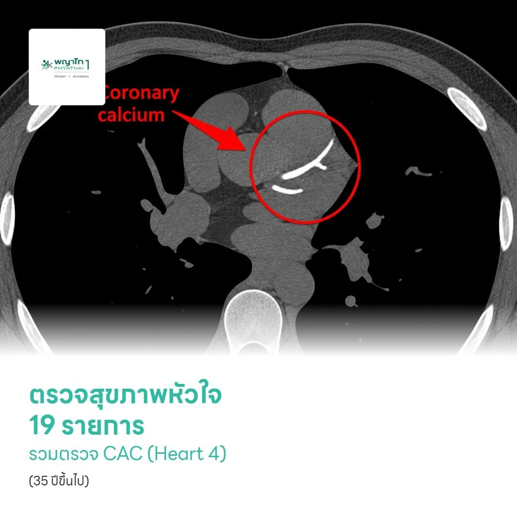 ตรวจสุขภาพหัวใจ 19 รายการ รวมตรวจ CAC (Heart 4) (35 ปีขึ้นไป)