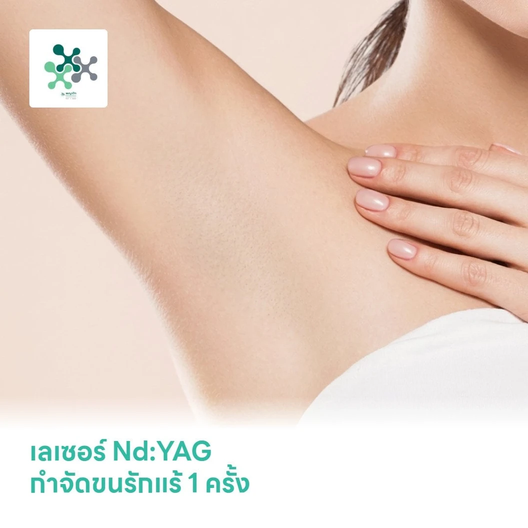 เลเซอร์ Nd:YAG กำจัดขนรักแร้ 1 ครั้ง