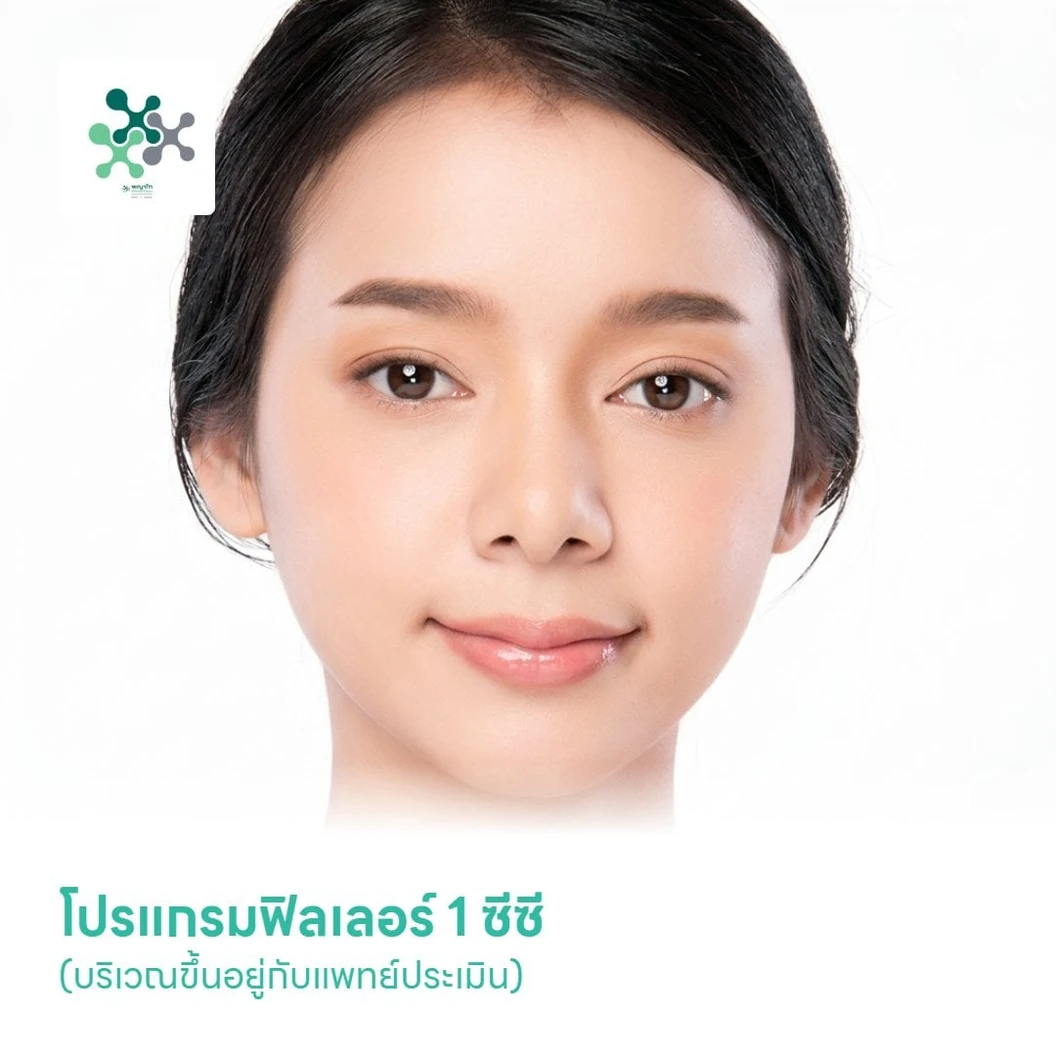 โปรแกรมฟิลเลอร์ 1 ซีซี (บริเวณขึ้นอยู่กับแพทย์ประเมิน)