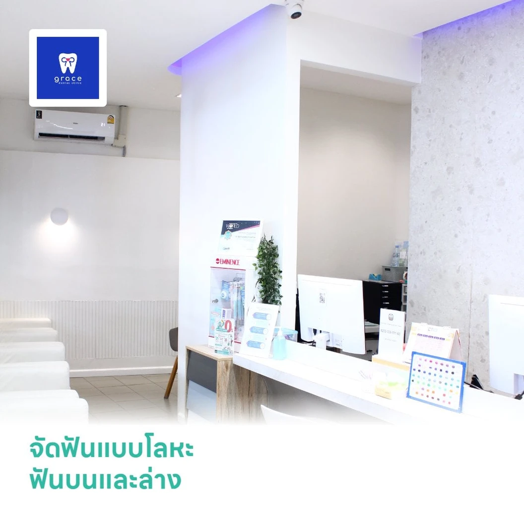 จัดฟันแบบโลหะ ฟันบนและล่าง