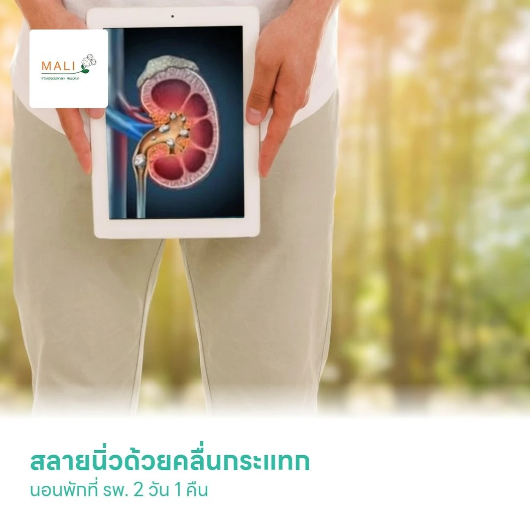 สลายนิ่วด้วยคลื่นกระแทก Extracorporeal Shock Wave Lithotripsy (EWSL) นอนพักที่ รพ. 2 วัน 1 คืน