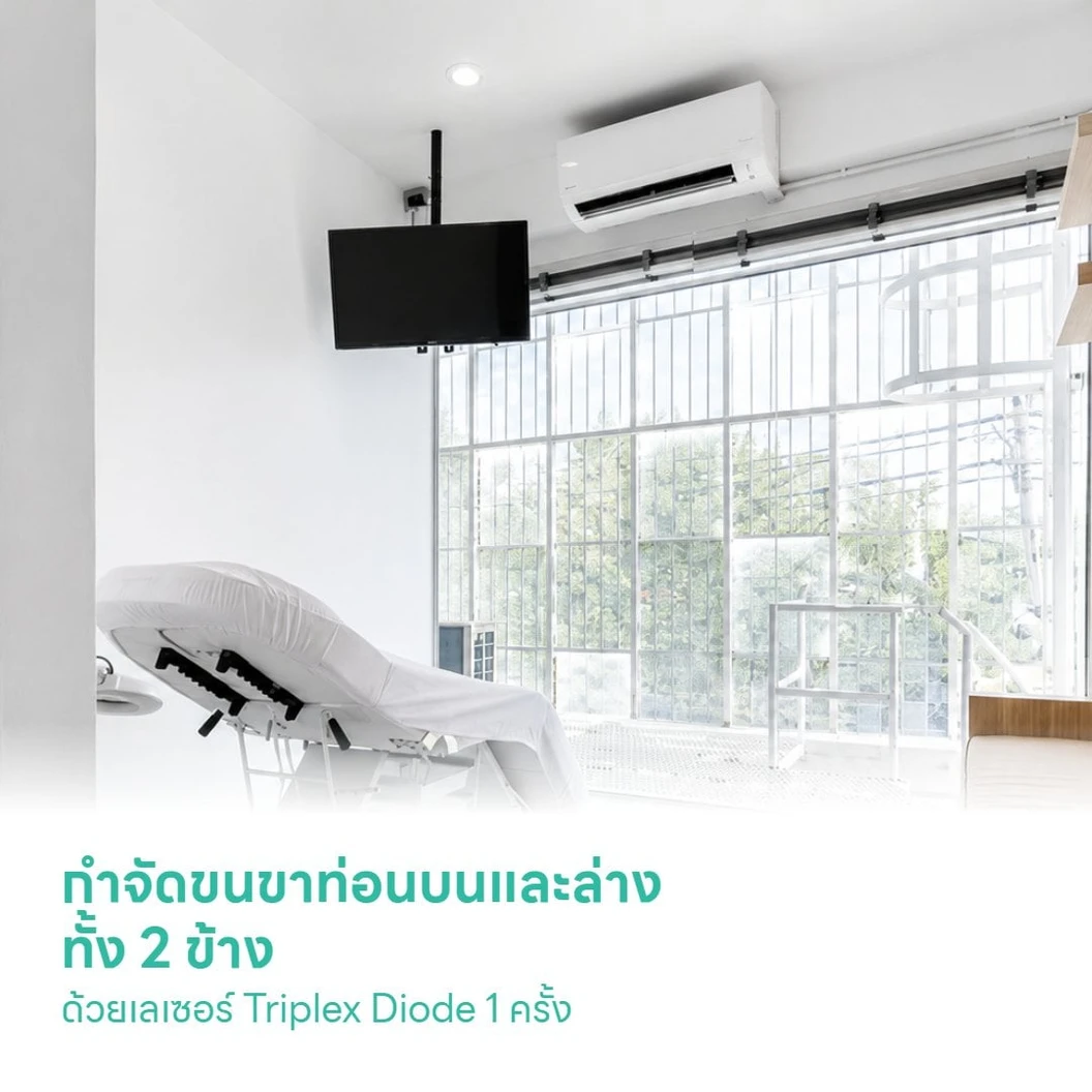 กำจัดขนขาท่อนบนและล่างทั้ง 2 ข้าง ด้วยเลเซอร์ Triplex Diode 1 ครั้ง สำหรับผู้หญิงหรือผู้ชาย