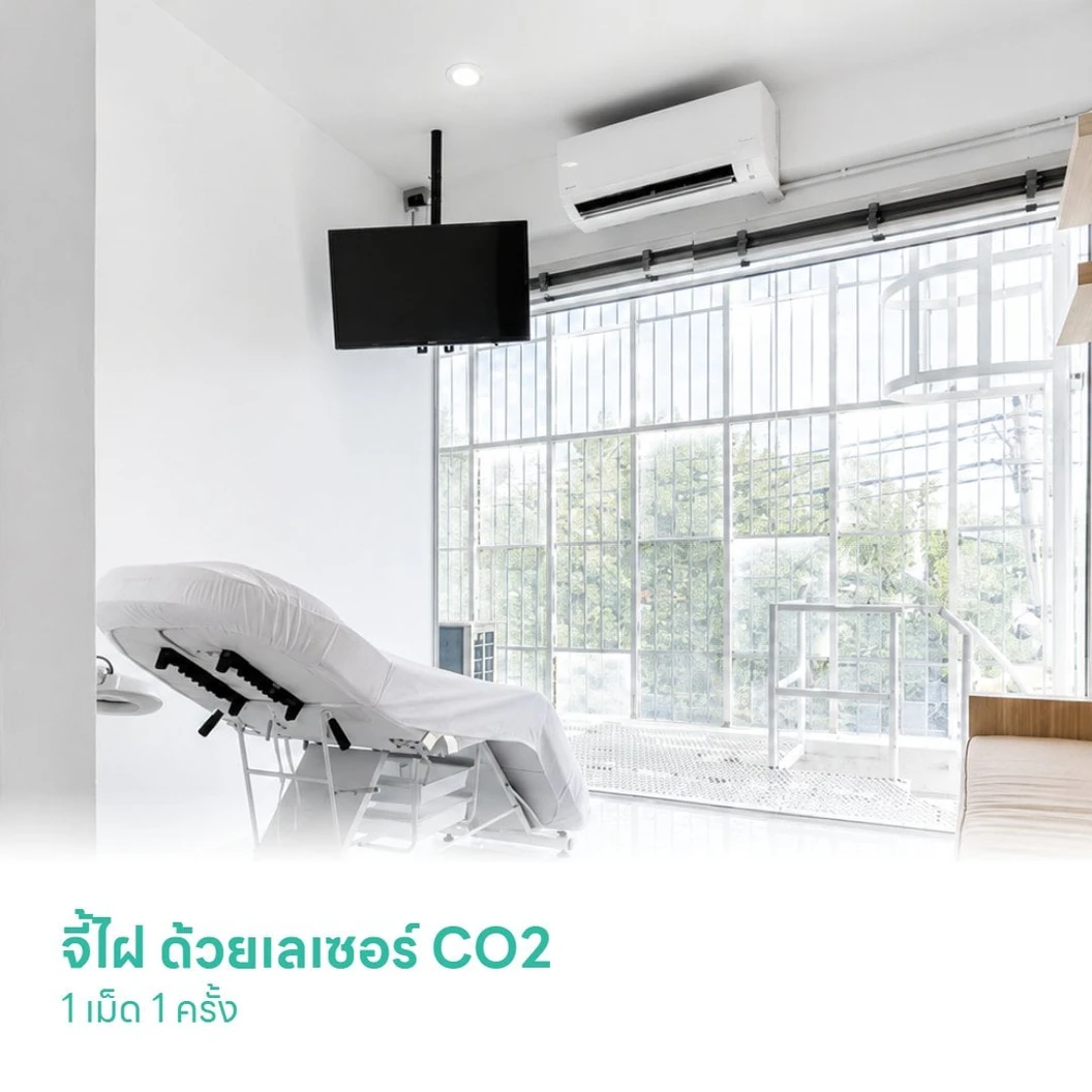 จี้ไฝ ด้วยเลเซอร์ CO2 1 เม็ด 1 ครั้ง