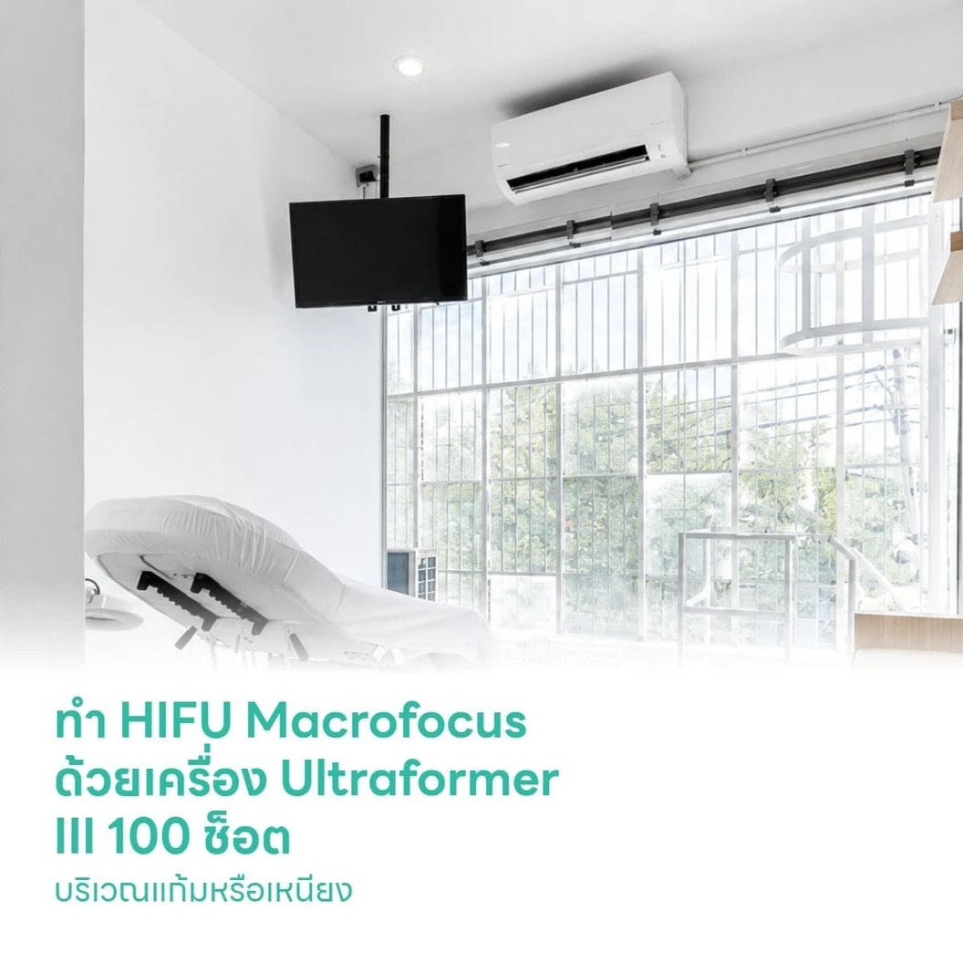 ทำ HIFU Macrofocus ด้วยเครื่อง Ultraformer III 100 ช็อต บริเวณแก้มหรือเหนียง ยกกระชับใบหน้าให้ดูอ่อนเยาว์ 1 ครั้ง