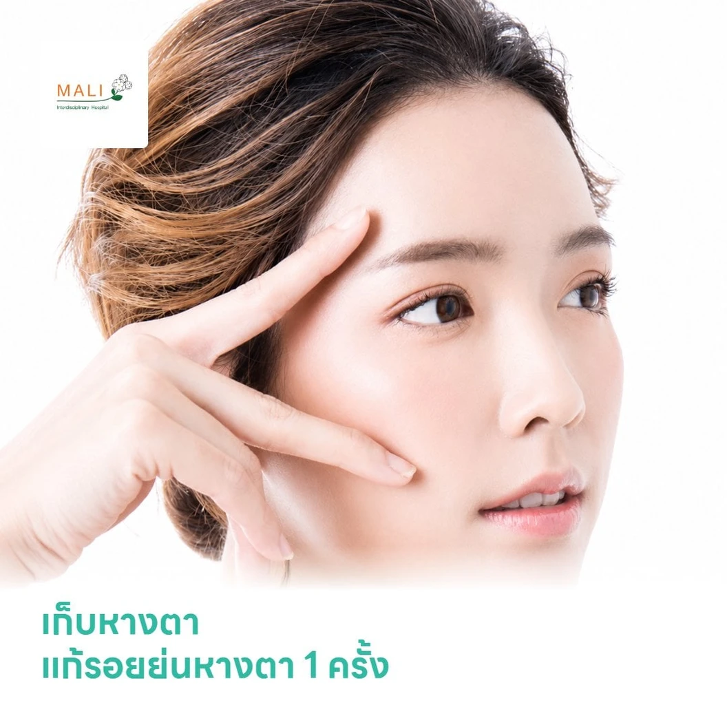 เก็บหางตา แก้รอยย่นหางตา 1 ครั้ง