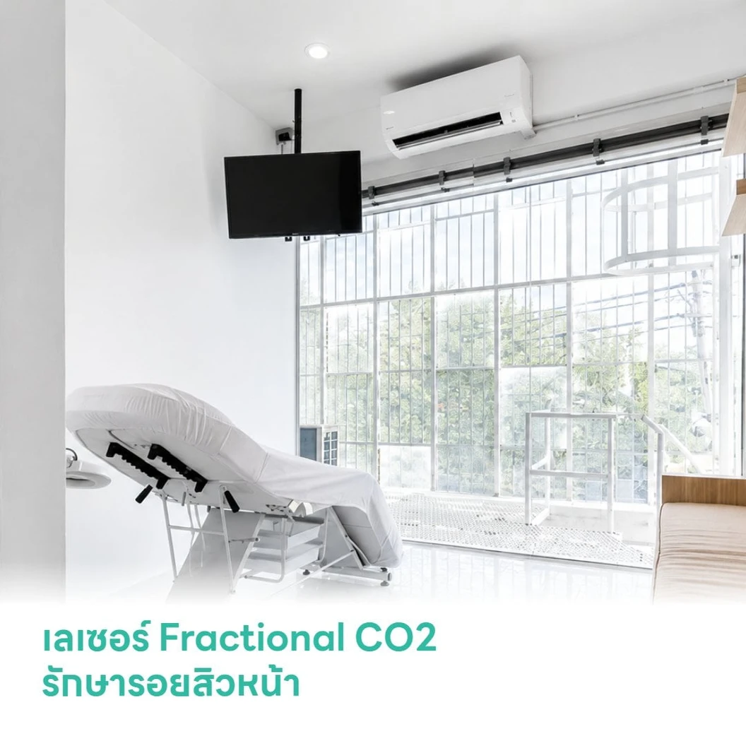 เลเซอร์ Fractional CO2 รักษารอยสิวหน้า