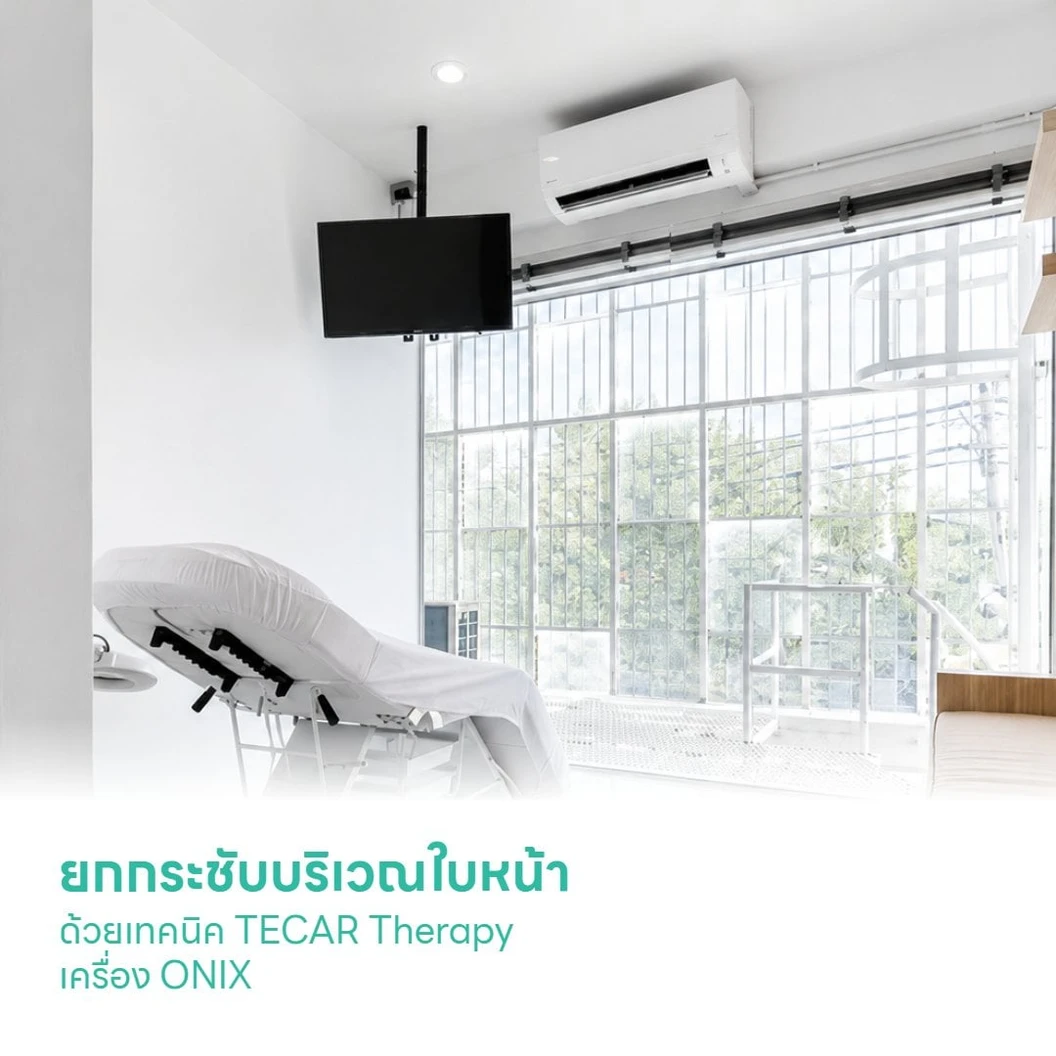 ยกกระชับบริเวณใบหน้า ด้วยเทคนิค TECAR Therapy เครื่อง ONIX