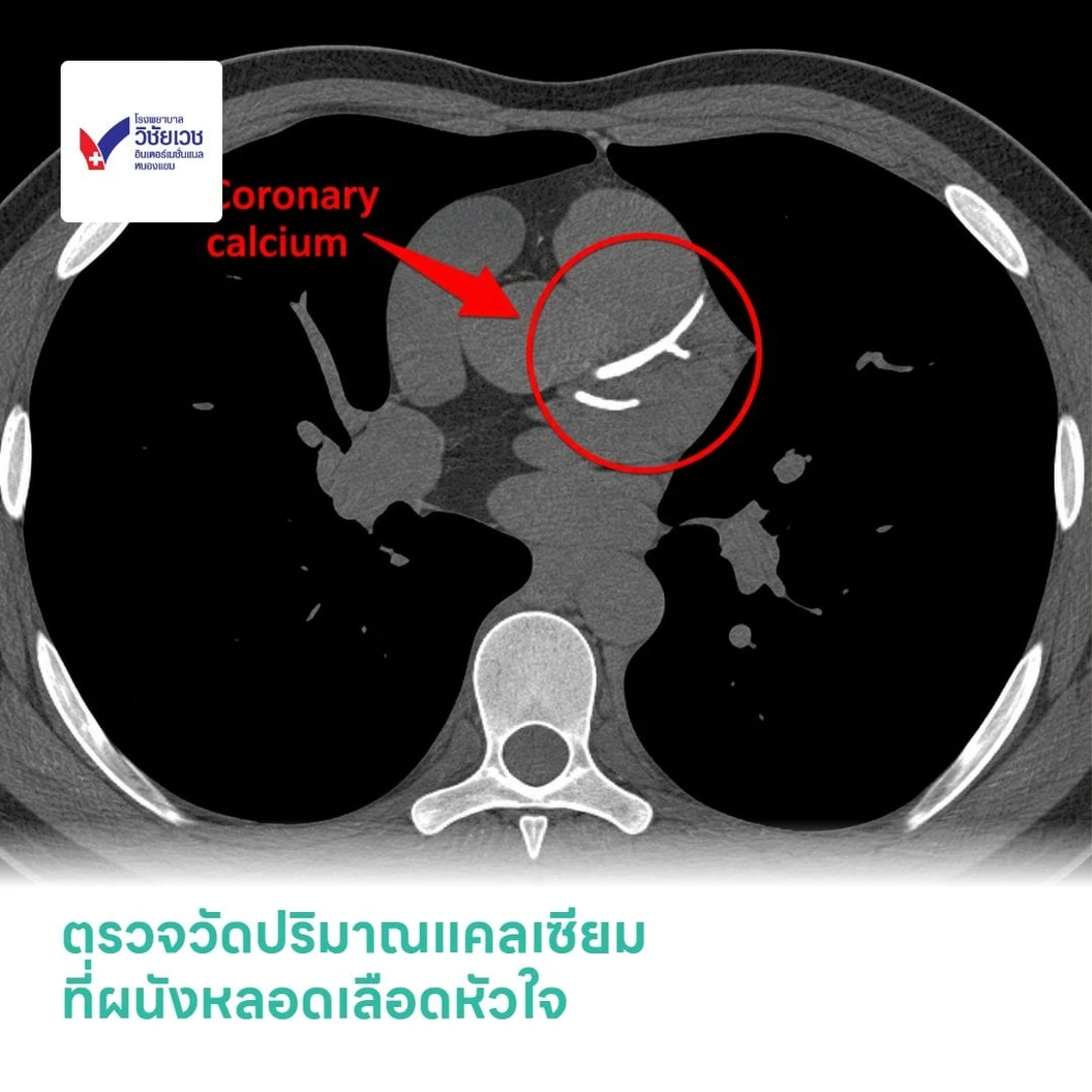 ตรวจวัดปริมาณแคลเซียมที่ผนังหลอดเลือดหัวใจ (Calcium Score)
