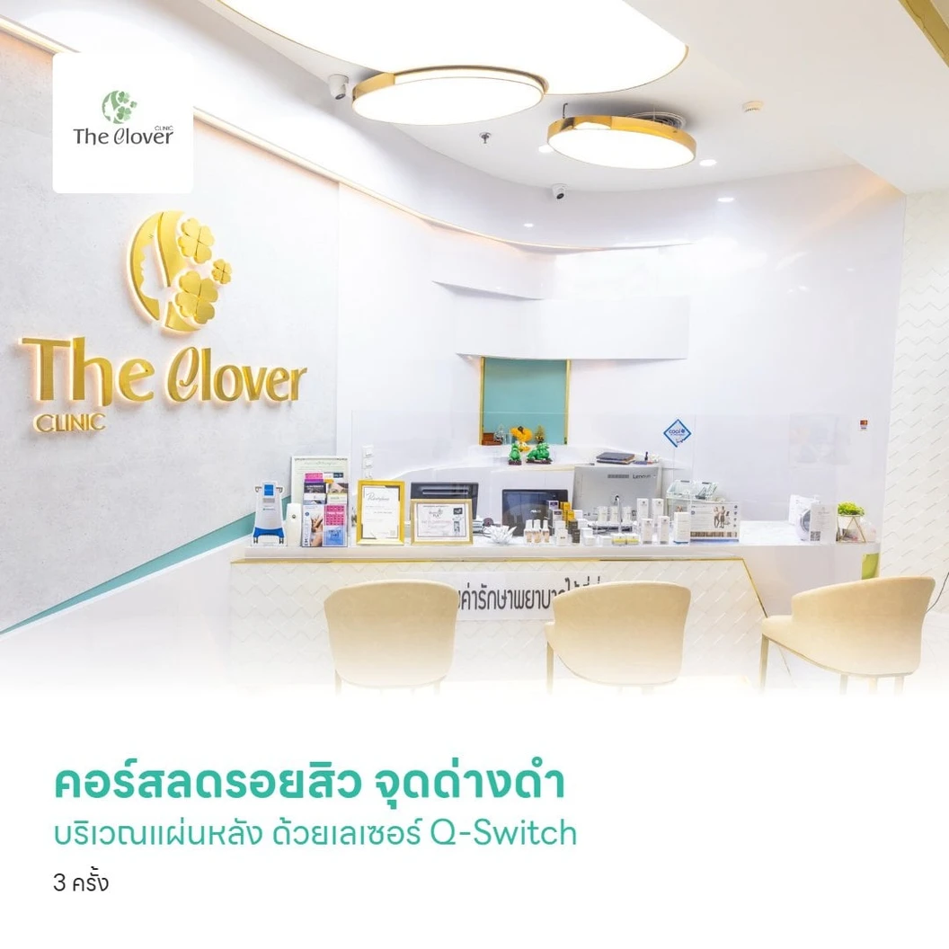 คอร์สลดรอยสิว จุดด่างดำ บริเวณแผ่นหลัง ด้วยเลเซอร์ Q-Switch 3 ครั้ง