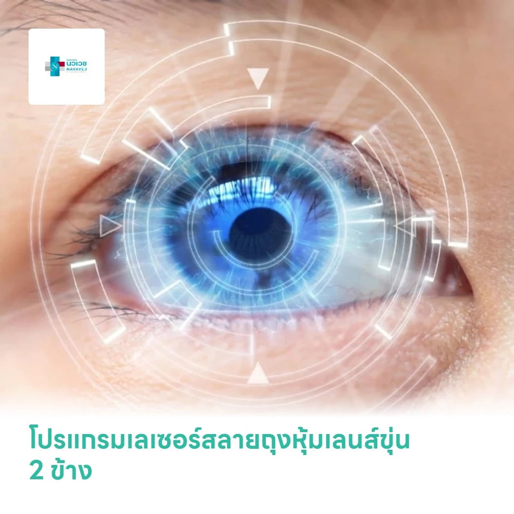 โปรแกรมเลเซอร์สลายถุงหุ้มเลนส์ขุ่น 2 ข้าง