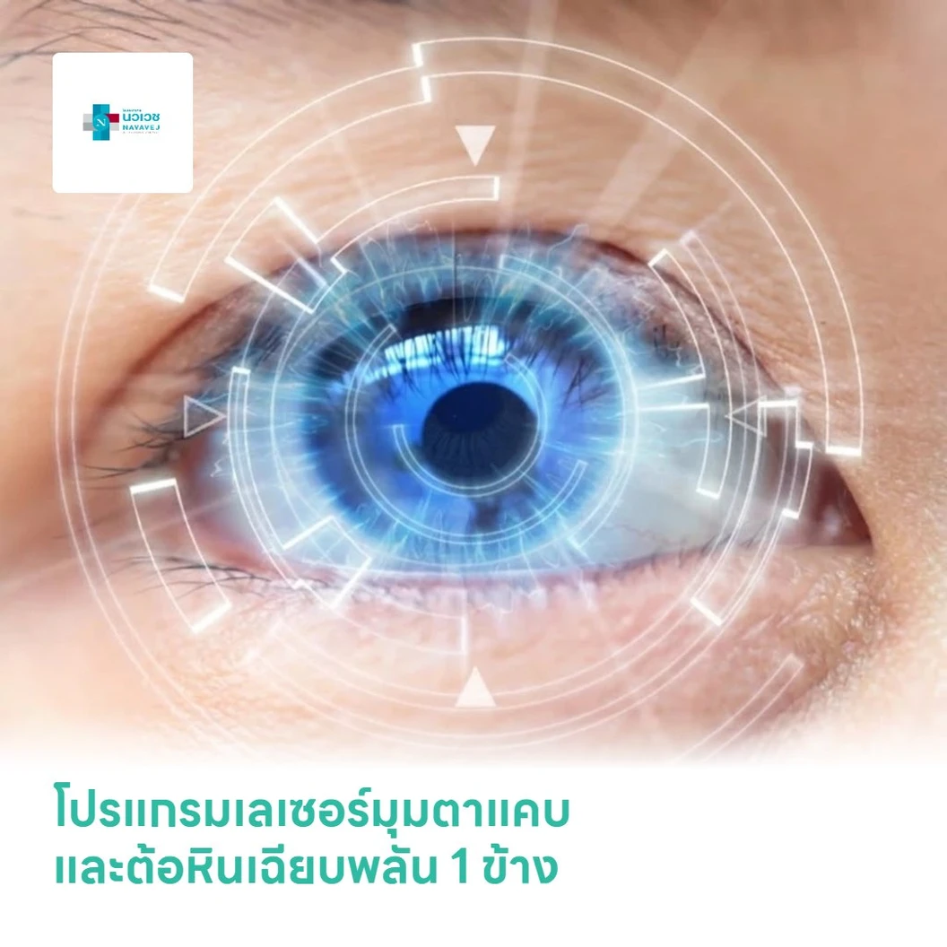 โปรแกรมเลเซอร์มุมตาแคบและต้อหินเฉียบพลัน 1 ข้าง