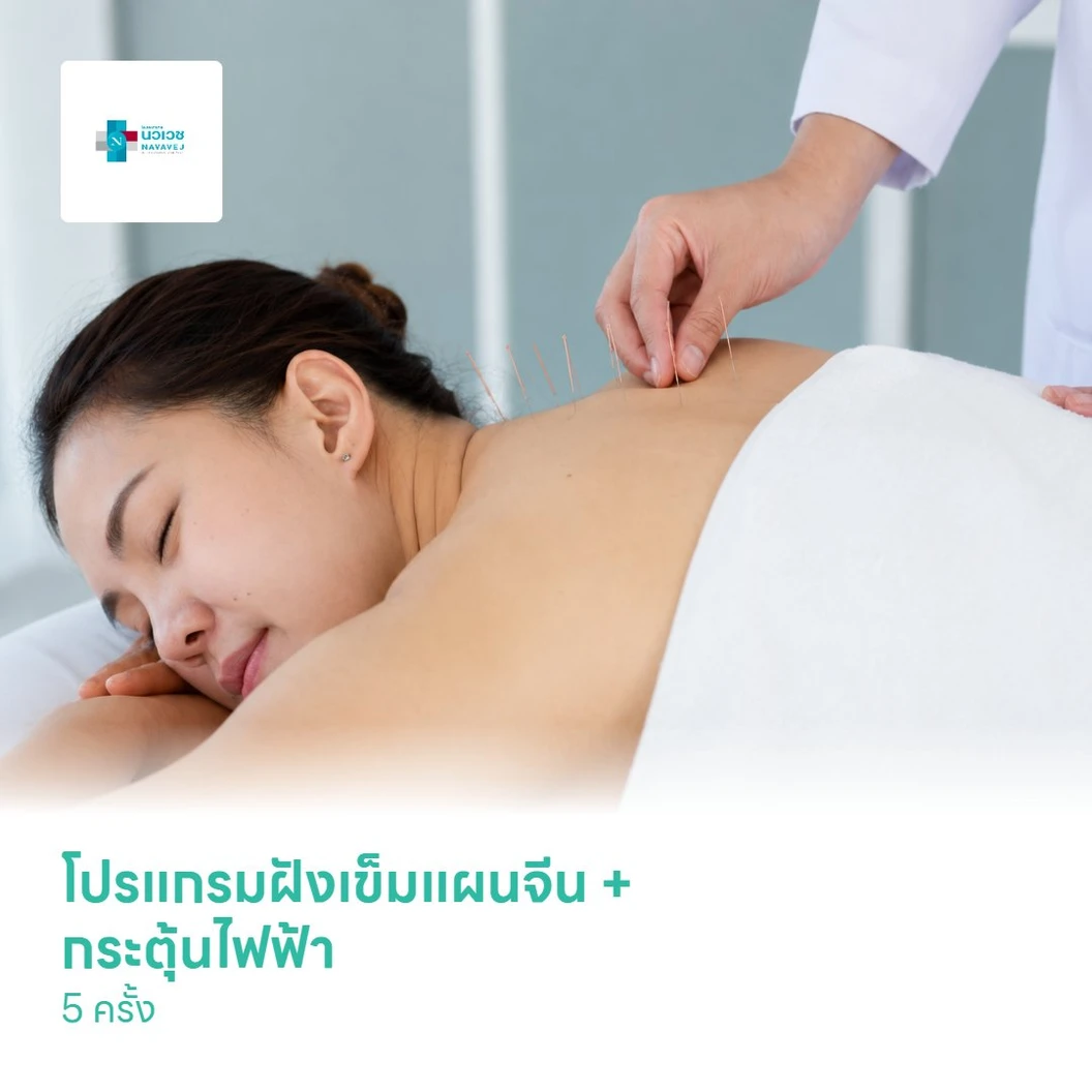 โปรแกรมฝังเข็มแผนจีน + กระตุ้นไฟฟ้า 5 ครั้ง