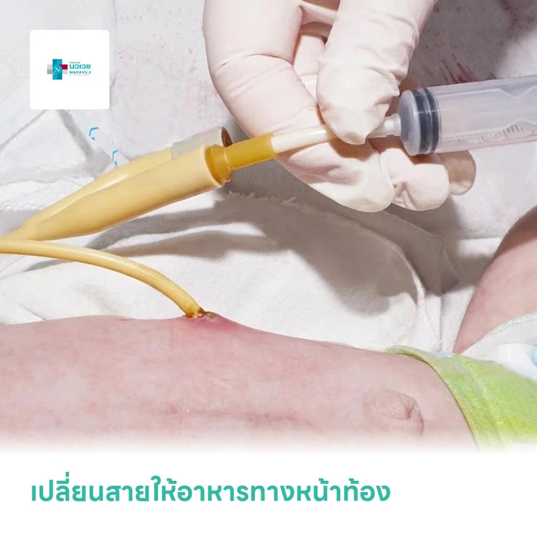 เปลี่ยนสายให้อาหารทางหน้าท้อง