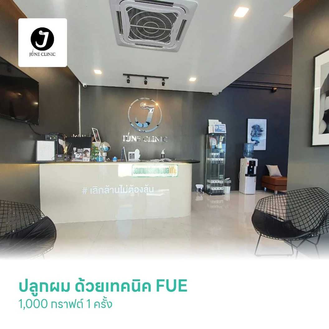 ปลูกผม ด้วยเทคนิค FUE 1,000 กราฟต์ 1 ครั้ง