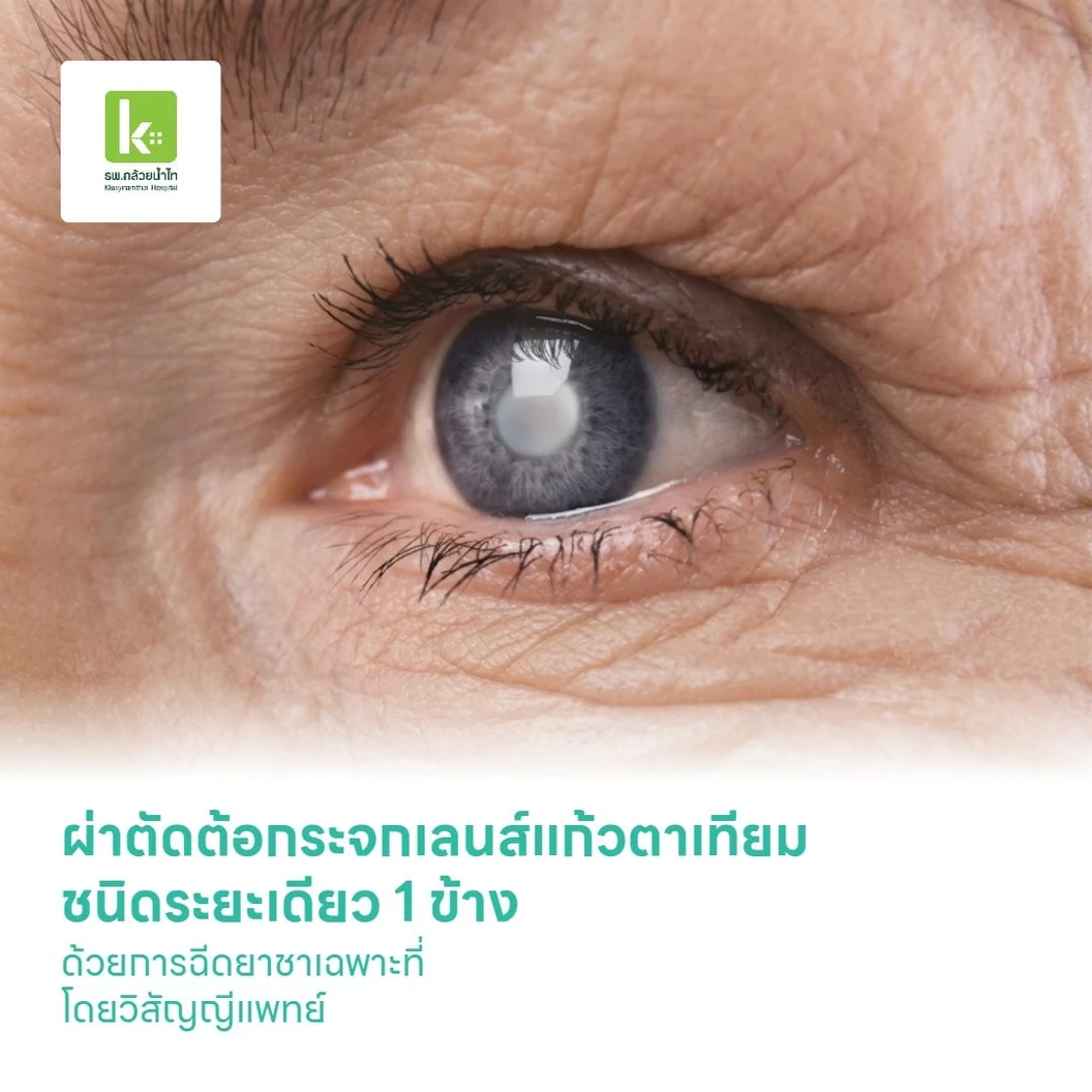 ผ่าตัดต้อกระจกเลนส์แก้วตาเทียม ชนิดระยะเดียว 1 ข้าง ด้วยการฉีดยาชาเฉพาะที่ โดยวิสัญญีแพทย์ (Monofocal IOL)