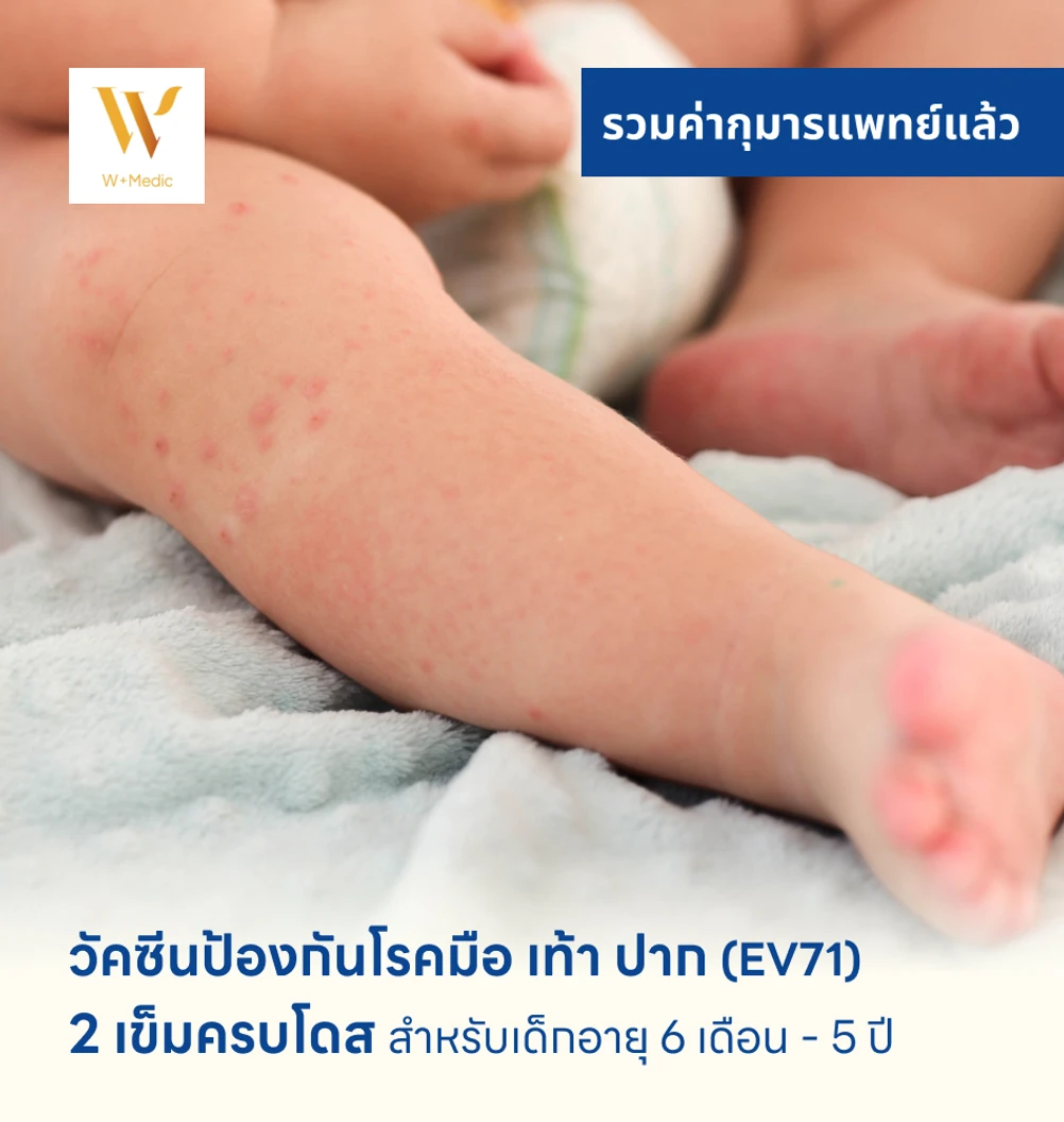 วัคซีนป้องกันโรคมือ เท้า ปาก 2 เข็ม (ครบโดส) สำหรับเด็กอายุ 6 เดือน-5 ปี