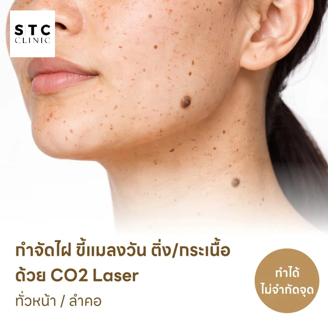 กำจัดไฝ ขี้แมลงวัน ติ่งเนื้อ กระเนื้อ ด้วย CO2 Laser ขนาดเส้นผ่านศูนย์กลางไม่เกิน 2 มม. ไม่จำกัดจุดทั่วใบหน้าหรือลำคอ 1 ครั้ง