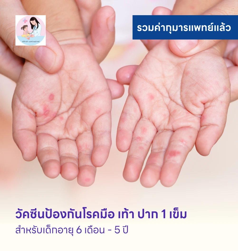 วัคซีนป้องกันโรคมือ เท้า ปาก 1 เข็ม สำหรับเด็กอายุ 6 เดือน-5 ปี