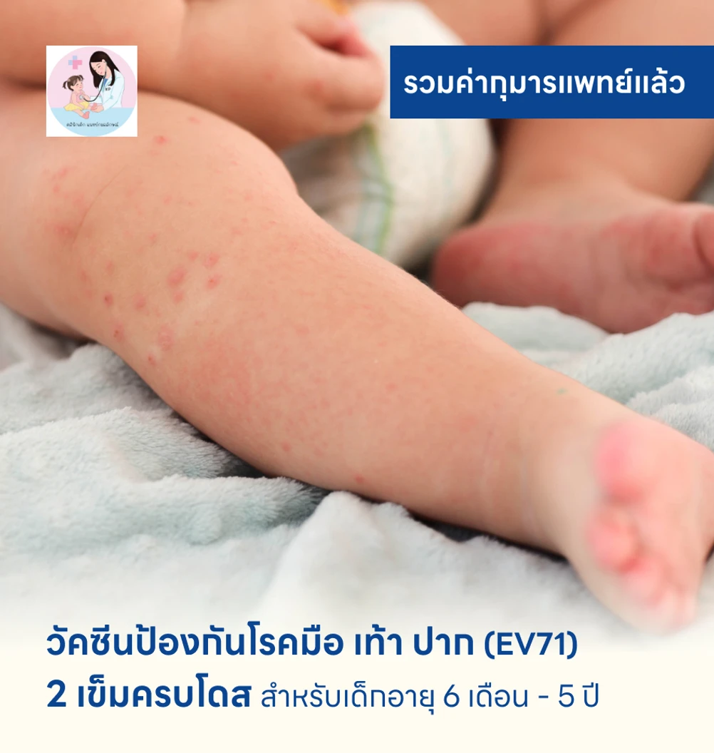 วัคซีนป้องกันโรคมือ เท้า ปาก 2 เข็ม (ครบโดส) สำหรับเด็กอายุ 6 เดือน-5 ปี