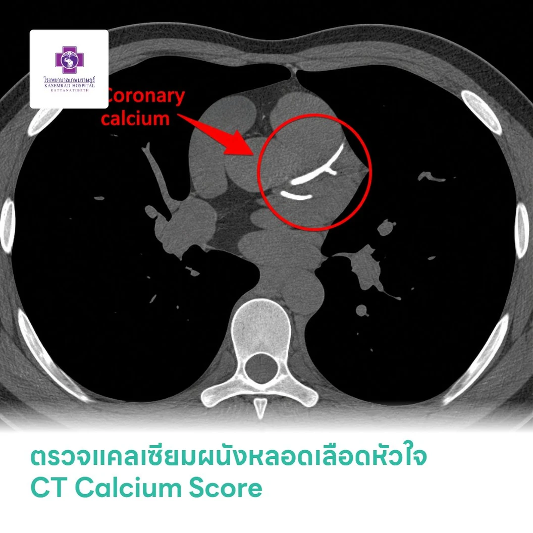 ตรวจแคลเซียมผนังหลอดเลือดหัวใจ CT Calcium Score