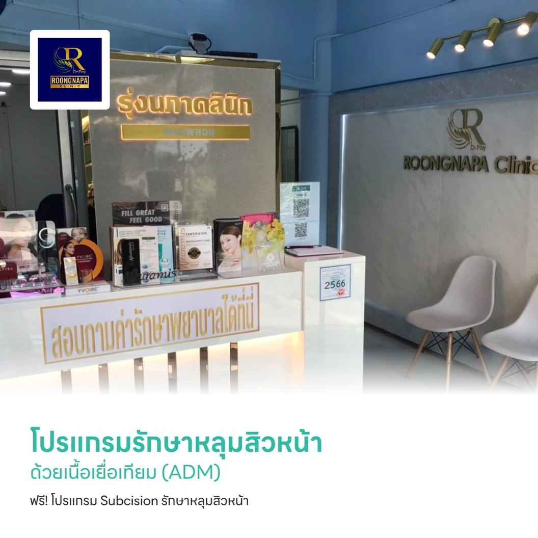 โปรแกรมรักษาหลุมสิวหน้า ด้วยเนื้อเยื่อเทียม (ADM) ฟรี! โปรแกรม Subcision รักษาหลุมสิวหน้า