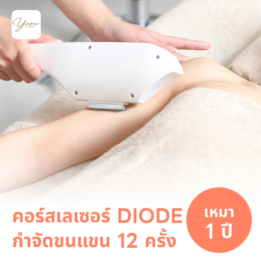 คอร์สเลเซอร์กำจัดขนทั่วแขน 12 ครั้ง ด้วย Diode Laser
