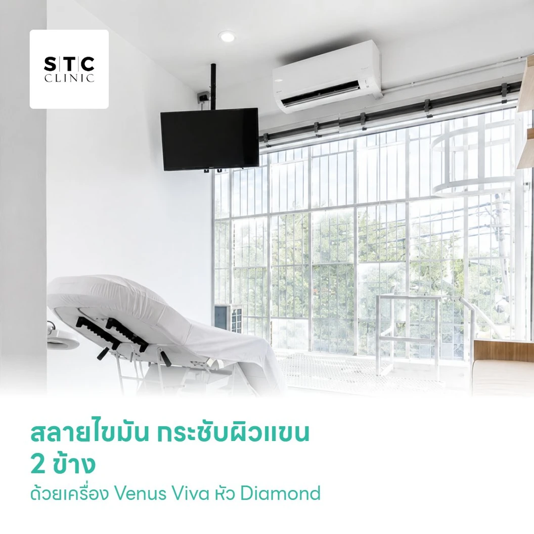 สลายไขมัน กระชับผิวแขน 2 ข้างด้วยเครื่อง Venus Viva หัว Diamond