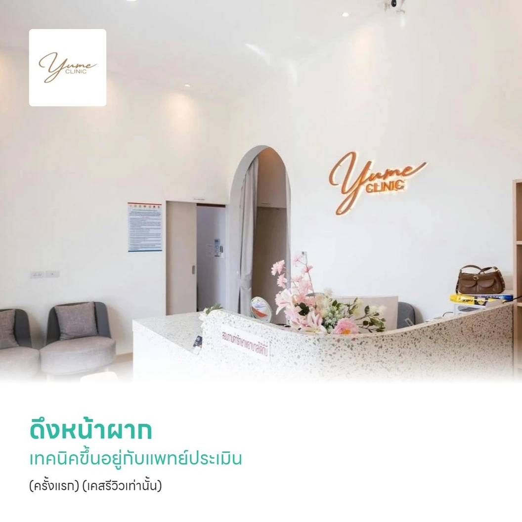 ดึงหน้าผาก เทคนิคขึ้นอยู่กับแพทย์ประเมิน (ครั้งแรก) (เคสรีวิวเท่านั้น)