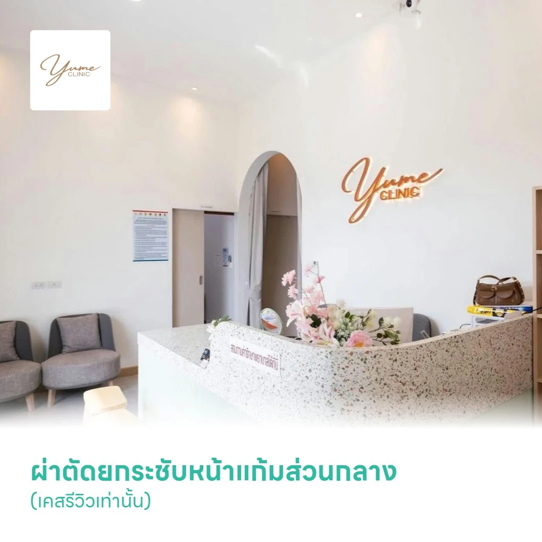 ผ่าตัดยกระชับหน้าแก้มส่วนกลาง (เคสรีวิวเท่านั้น)